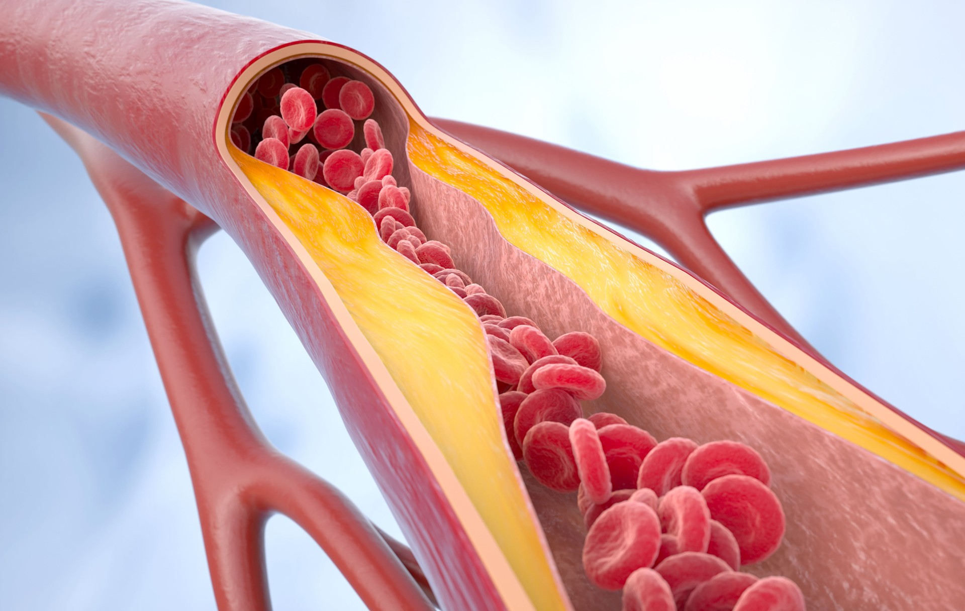 Atherosclerosis disease. Cholesterol in the blood vessels